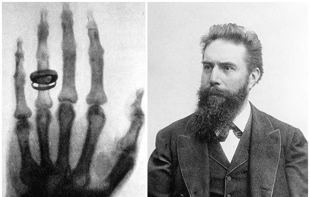 伦琴在发现X射线的时候给他的妻子拍了1张带有戒指的右手照片